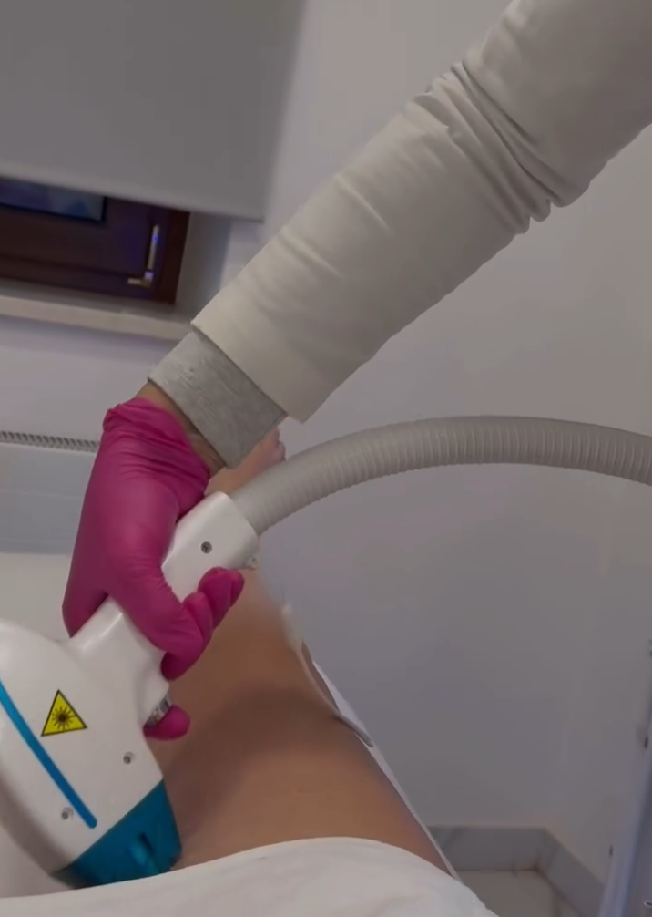 Alma Soprano laser uklanjanje dlačica